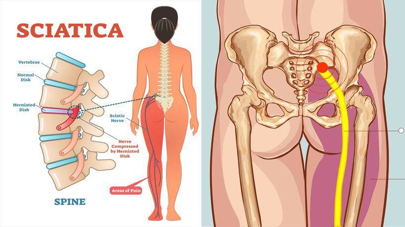 Sciatica Pain Relief That Lasts