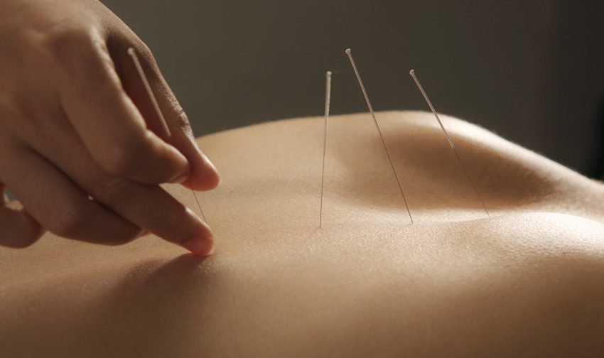 What to Expect During Your First Acupuncture Session in Kitchener?