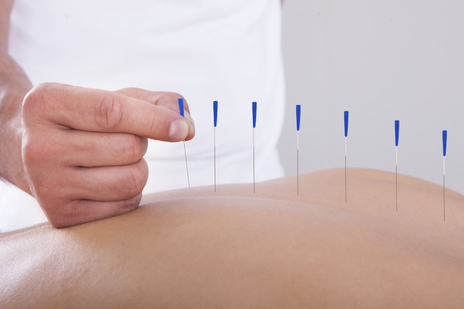 The Benefits of Acupuncture